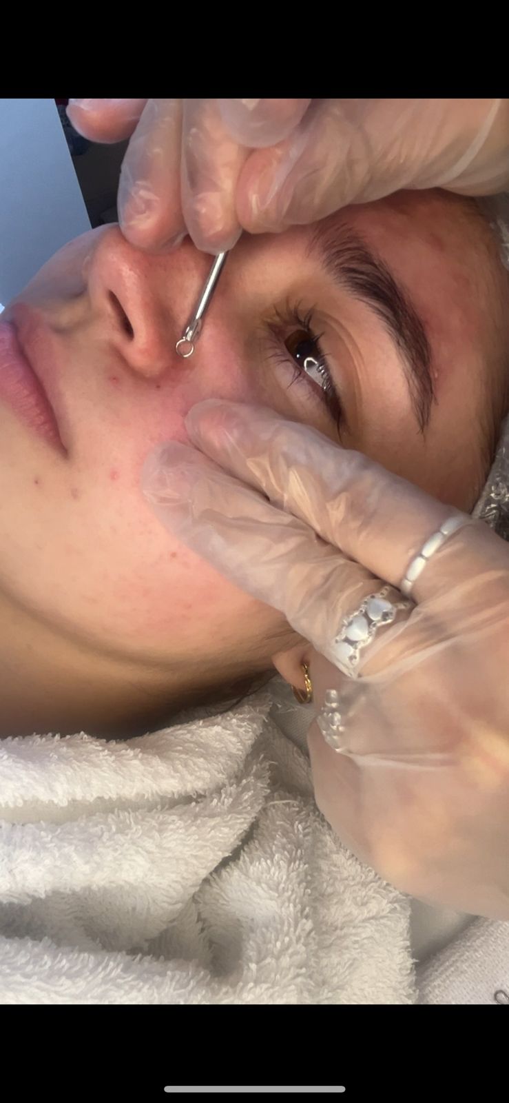 Limpeza De Pele (com  Ou Sem Extração )