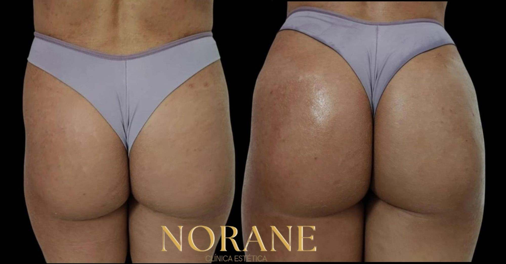 Preenchimento De Glúteo